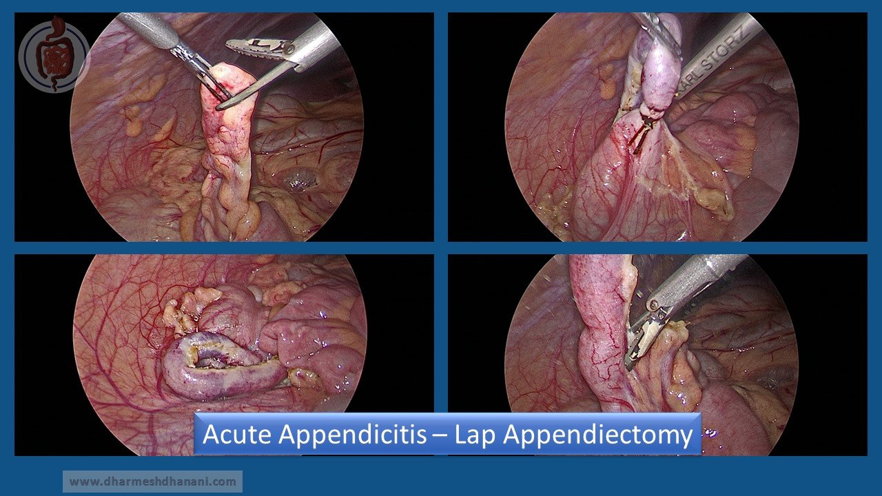 Acute Appendicitis (3)