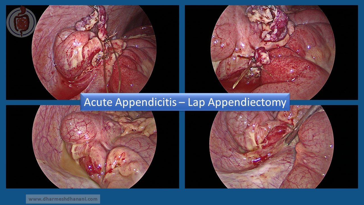 Acute Appendicitis (4)