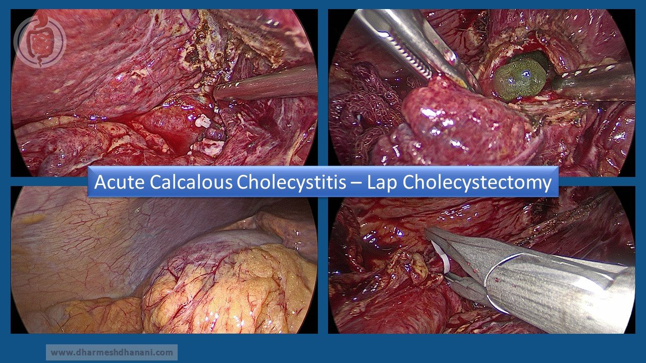 Acute Calcalous Cholecystitis