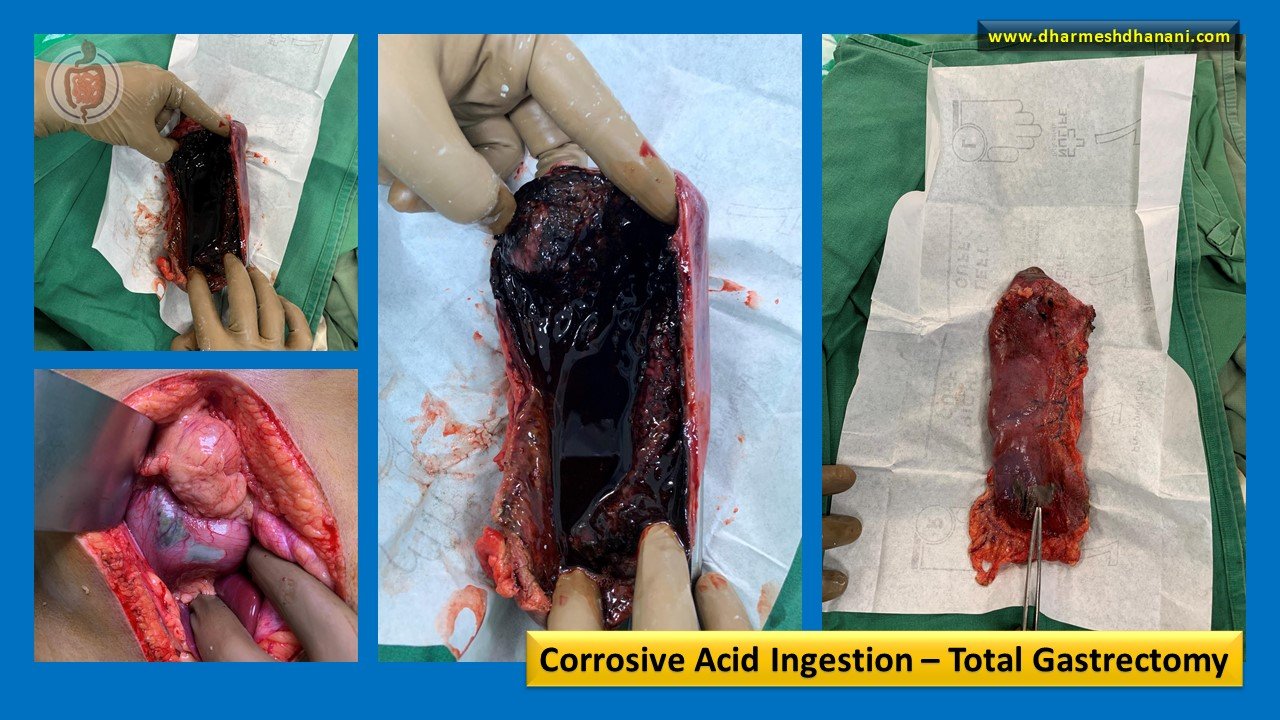 Corrosive Acid Injury