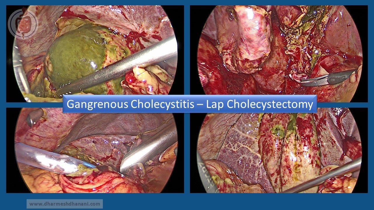Gangrenous Cholecystitis (3)