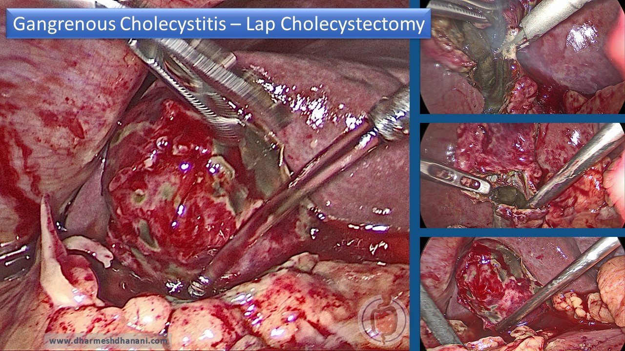 Gangrenous Cholecystitis - Lap Cholecystectomy