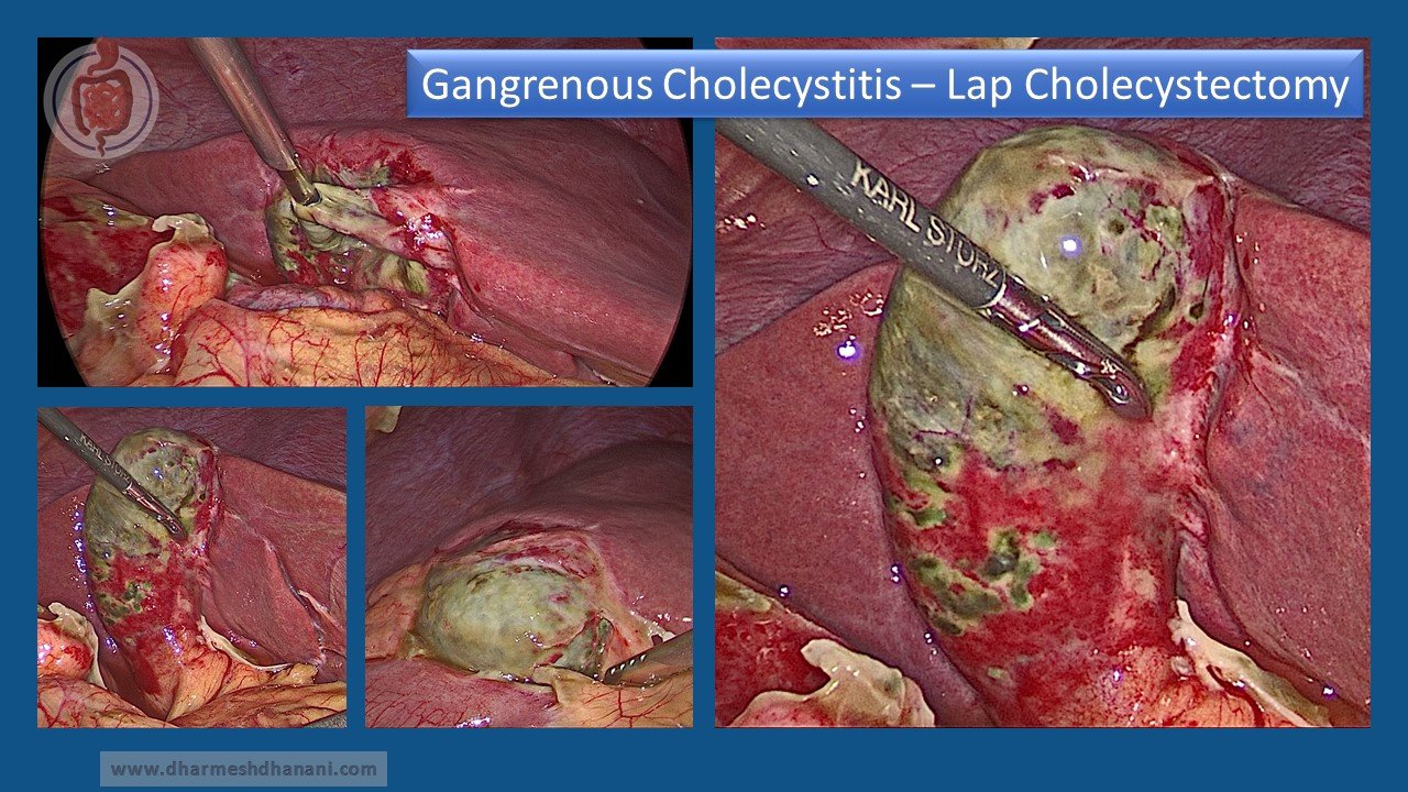 Gangrenous Cholecystitis