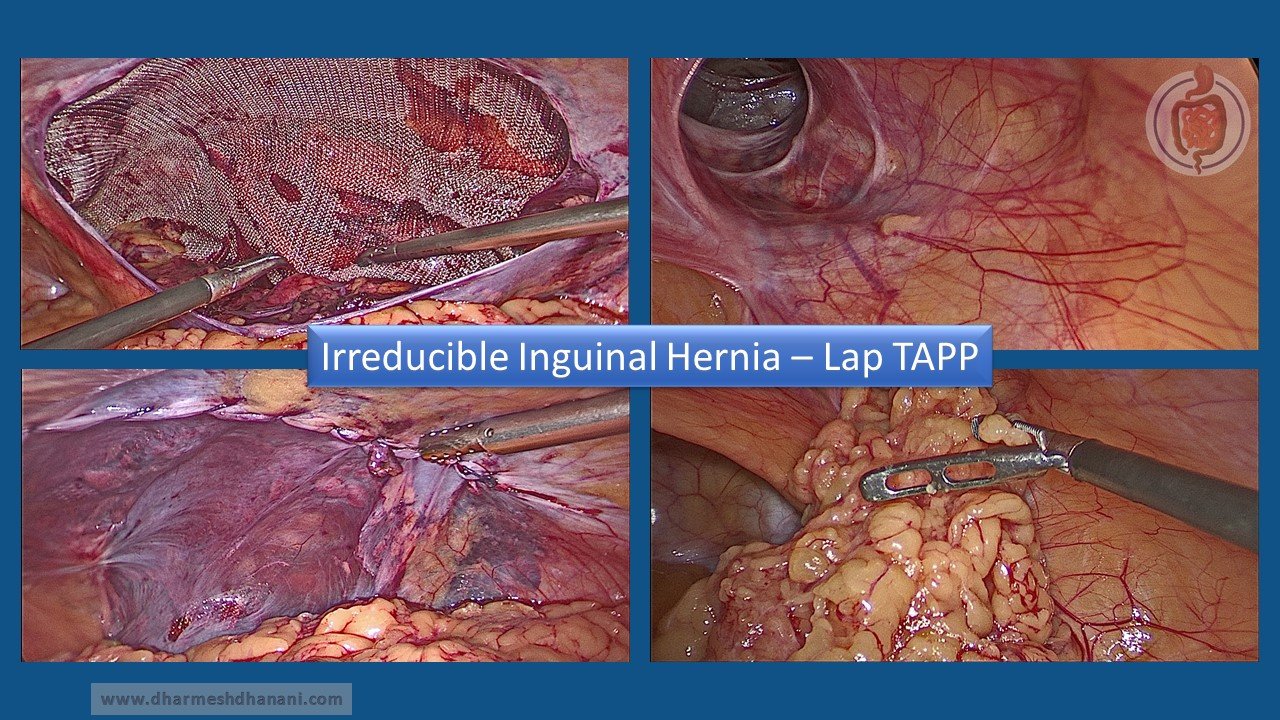Irreducible Inguinal Hernia - TAPP