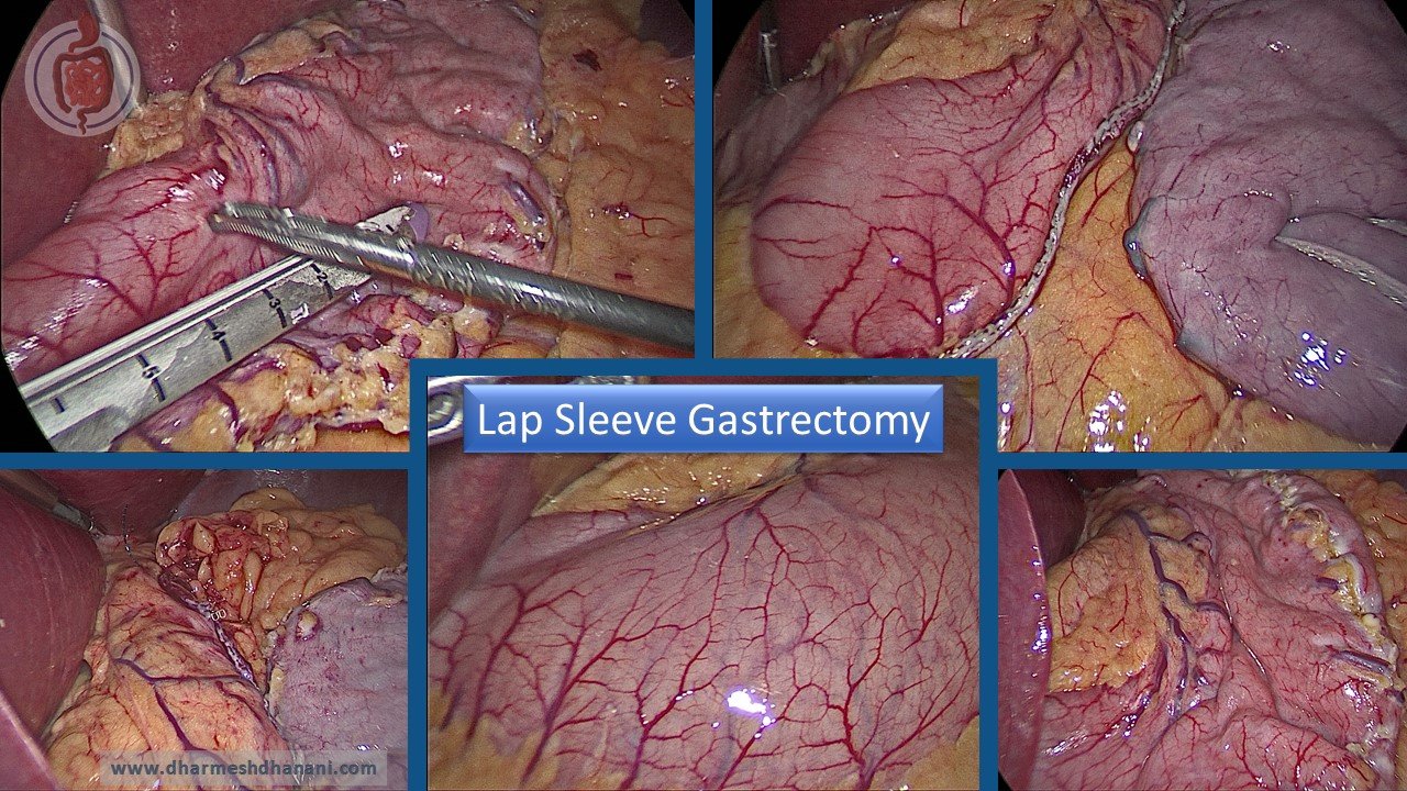 Lap Sleeve Gastrectomy