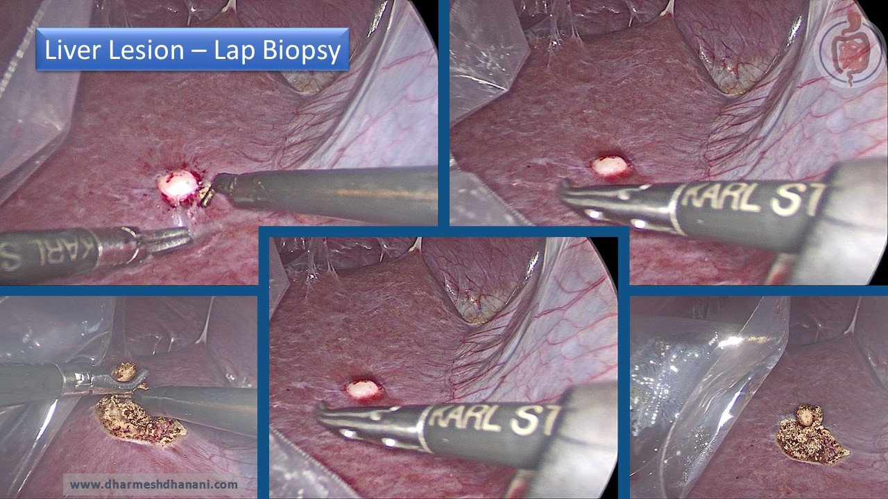 Liver Lesion - Biopsy