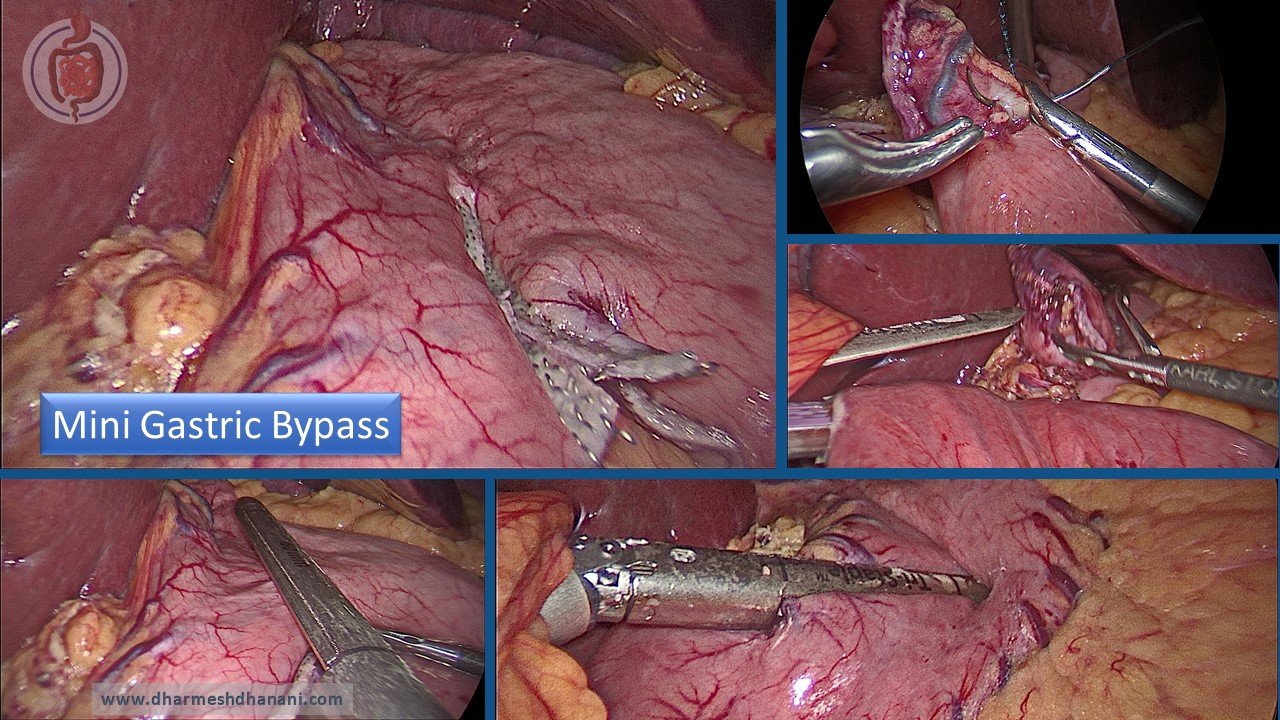Mini Gastric Bypass (2)