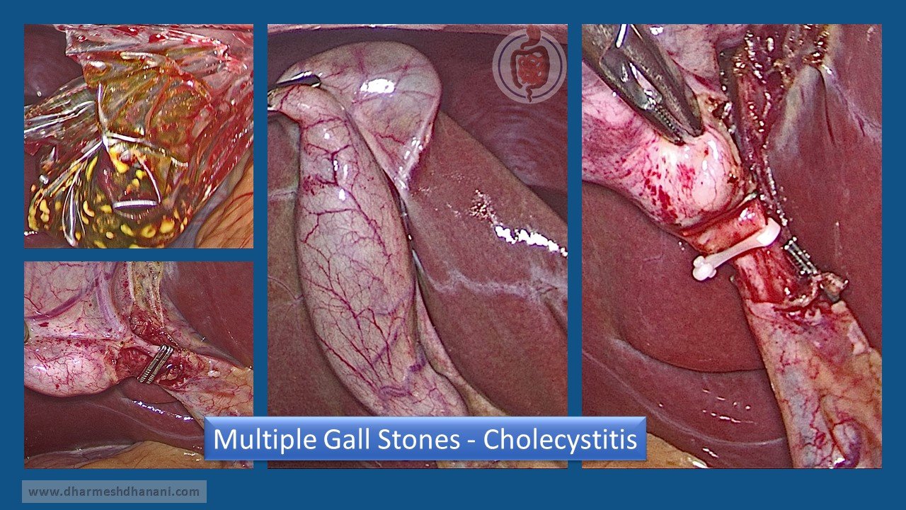 Multiple Gall Stones - Cholecystitis