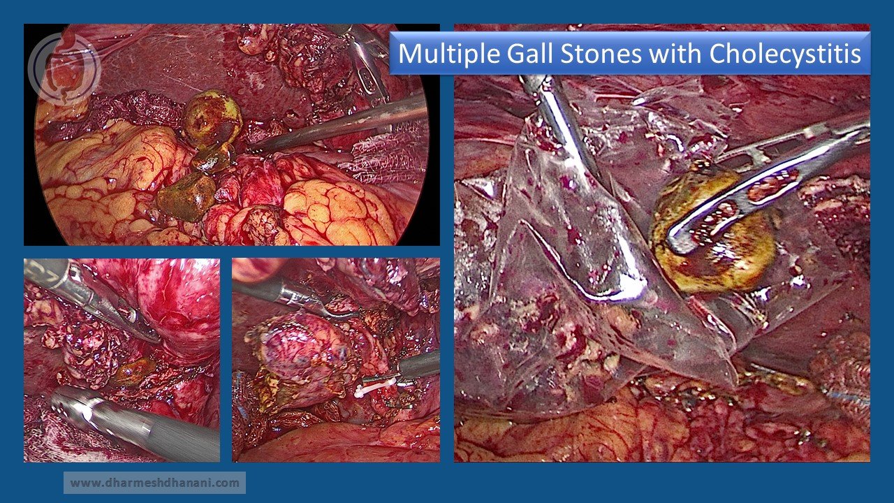 Multiple Gall Stones