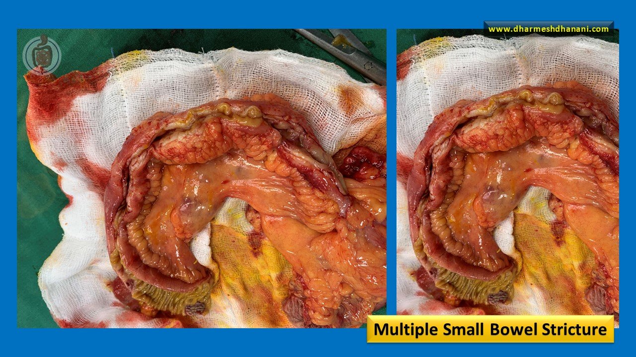 Multiple Small Bowel Stricture
