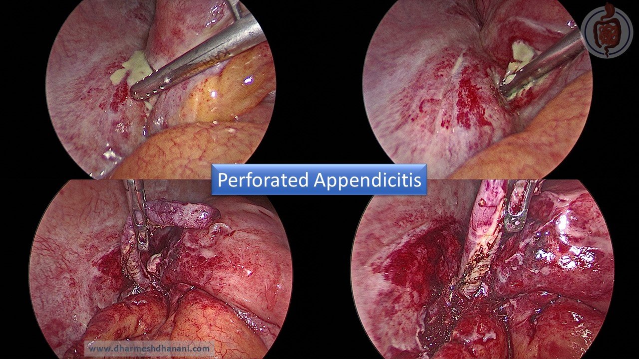 Perforated Appendicitis