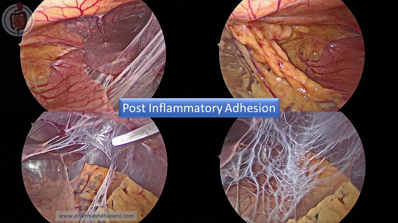 Post Inflammatory Adhesion