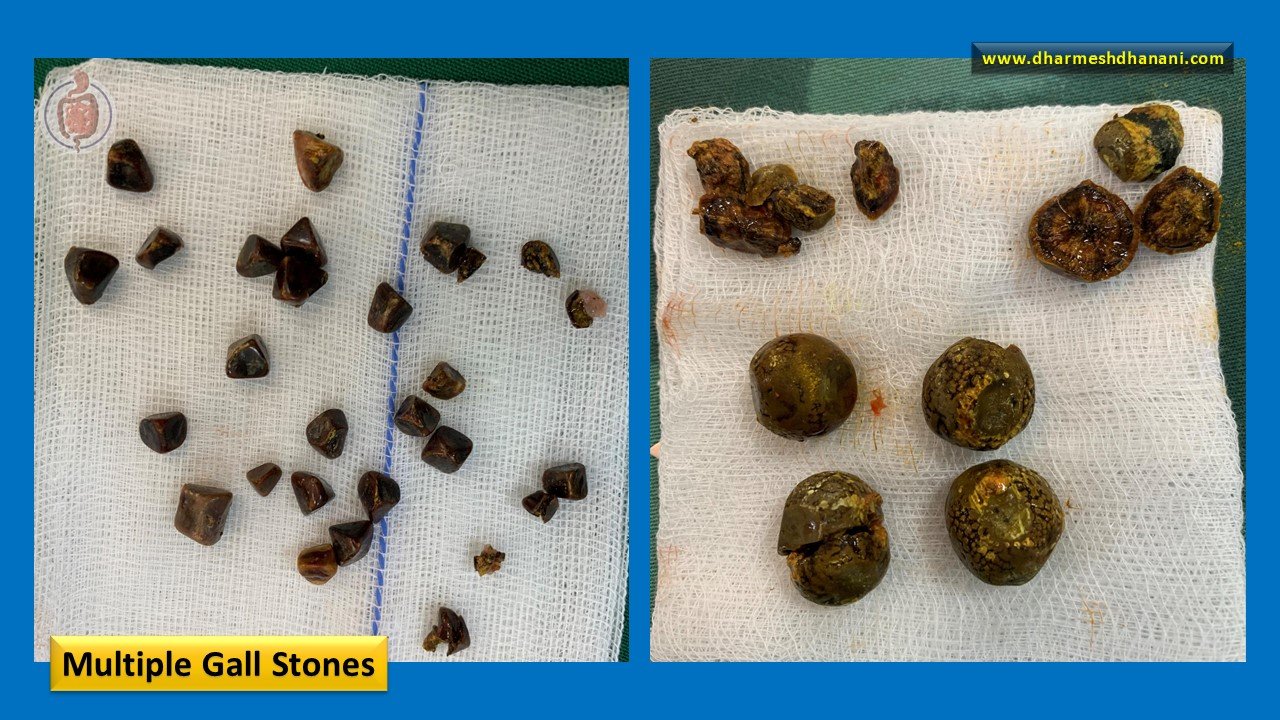 gall stones (2)