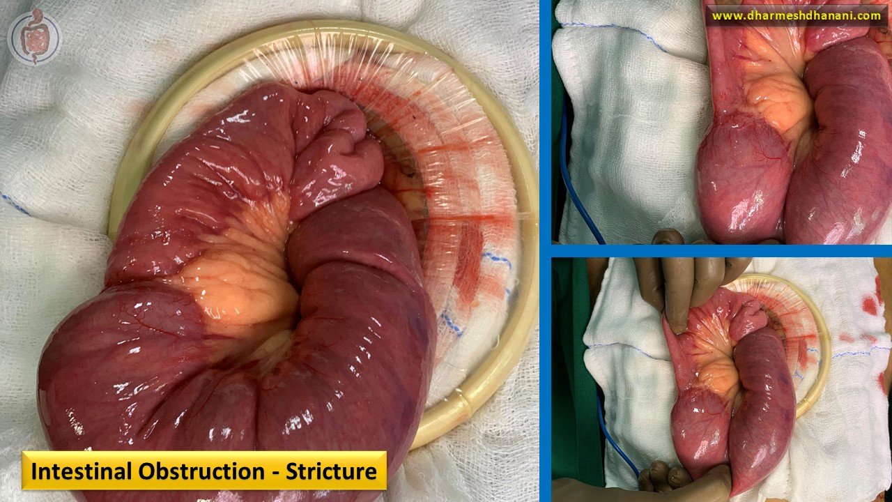 stricture with obstruction (2)