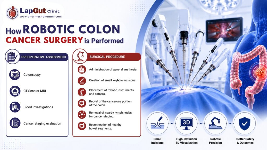 Robotic Colon Cancer Surgery in surat